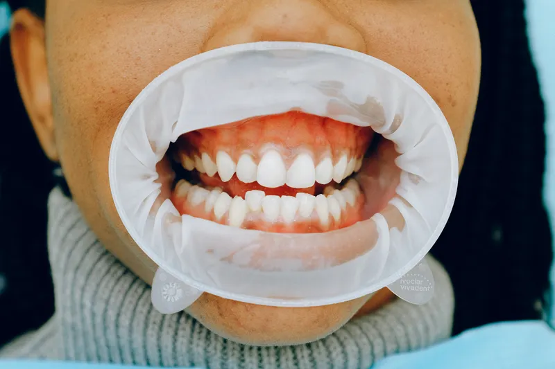 Close-up of front teeth and pink gums held open with a soft plastic cheek holder during a check-up.